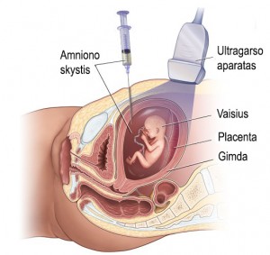Amnioce. Nuotr. stanfordchildrens.org