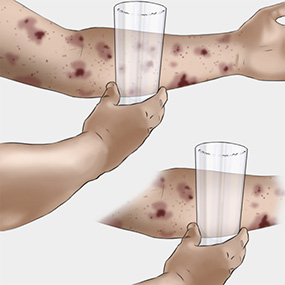 Pastebėjus raudonus bėrimus odoje, juos reikia įspausti stikline: meningokokiniam sepsiui būdingas bėrimas neblykšta, spaužiant išlieka. Nuotr. healthline.com