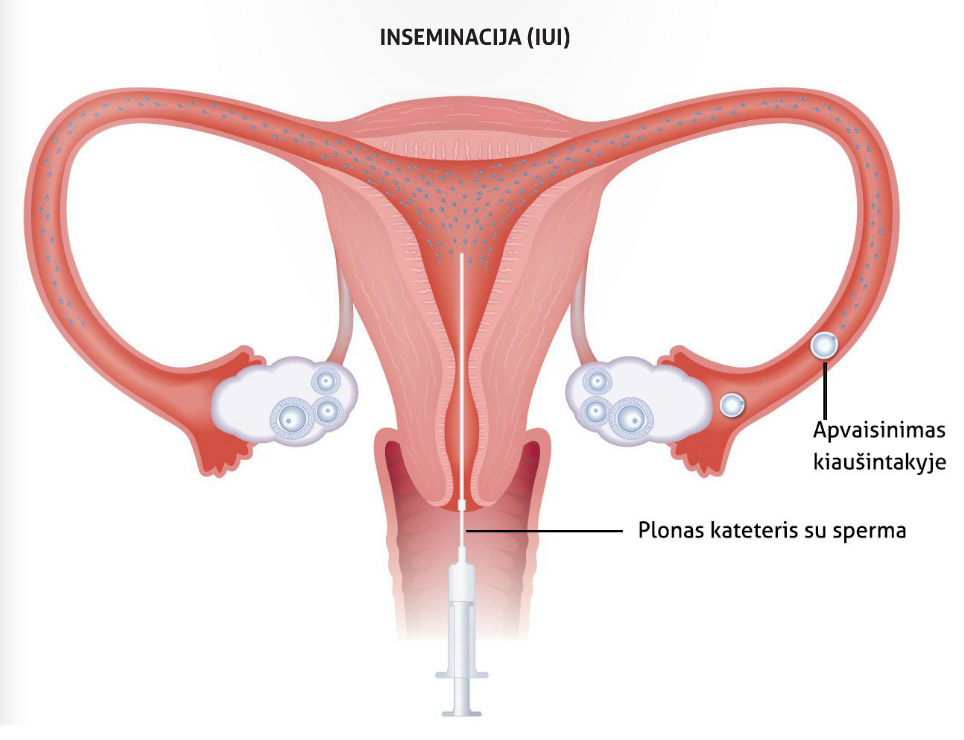 Intrauterininė inseminacija (IUI)